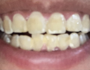 Teeth Stains