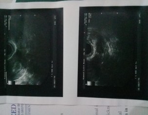 Trying To Conceive After Miscarriage 