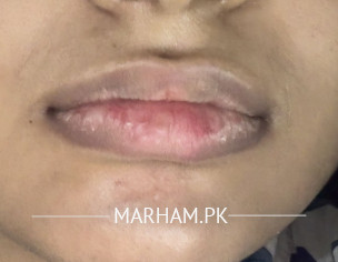 Dry Damaged Cracked Black Lips