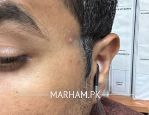 Pimples Or Black Heads Or ??