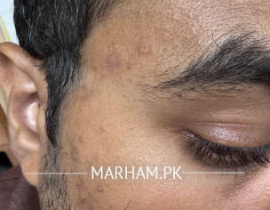 Pimples Or Black Heads Or ??