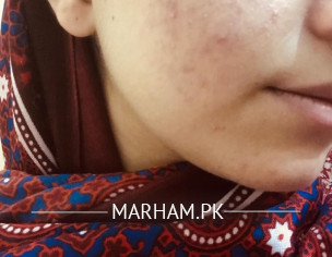 Post Marks And Acne Issue