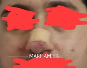 Active Acne On Face, Nose And Forehead