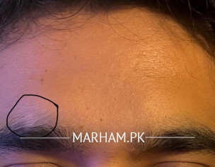 SKIN PROBLEM ON HEAD AND FACE