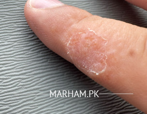 Skin Problem On My Finger 