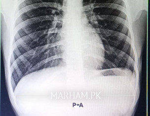 Left CP Angle Obliteration