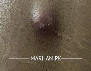 Sebaceous Or Epidermoid Cyst