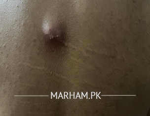 Sebaceous Or Epidermoid Cyst