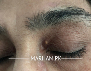 White Spot On Left Eye 