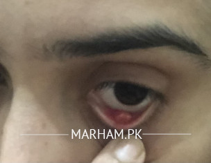 Pimples Inside Lower Eye Lid 