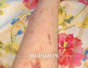 Itching In Pregnancy 