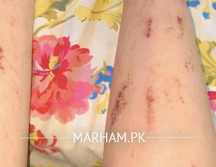 Itching In Pregnancy 