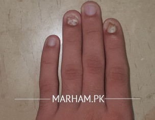 Irregular Nails Growth Problem