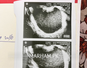 Endometriomas (chocolate Cyst)