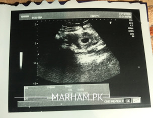 Anembryonic Pregnancy