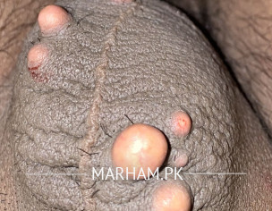 Sebaceous Cysts On Scrotrum