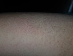 Itching ,and Redness