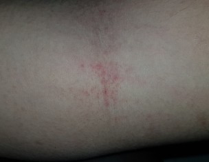 Itching ,and Redness