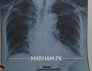 Chest X-ray
