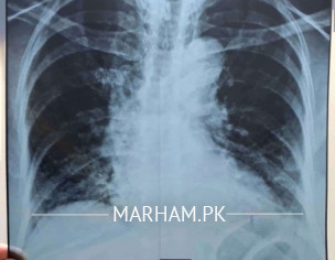 Chest X-ray