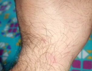 Itching / Scratching