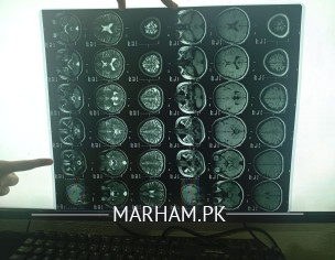 Open MRI BRAIN