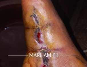 Wound After Accident (diabetic)