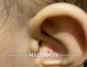 Ear Isssue( Left Ear)