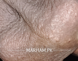 White Pimples/Cyst On Testicles.