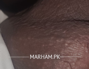 White Pimples/Cyst On Testicles.