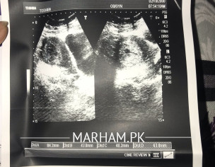 Blighted Ovum Pregnancy 