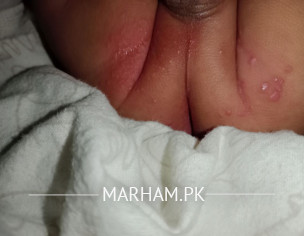 Nappy Rash