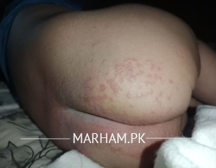 Nappy Rash