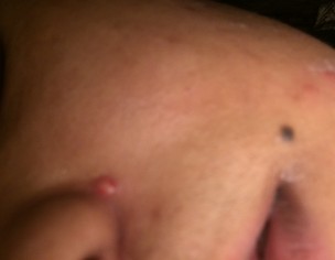 Weird Pimple Beside Nose 