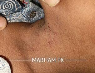 بچے کے جسم پر بارش کی وجہ سے بننے والے دانے