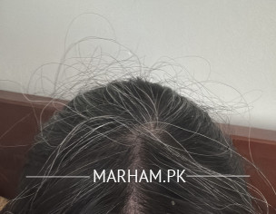 Premature Grey Hairs