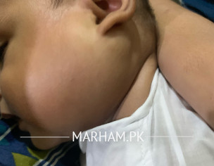 Enlarged Left Parotid Gland, Vascular Surgeon 