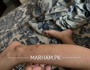 Scars Due To Mosquito Bites