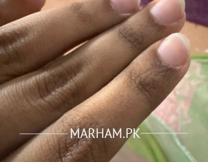 Dark Knuckles And Areas 