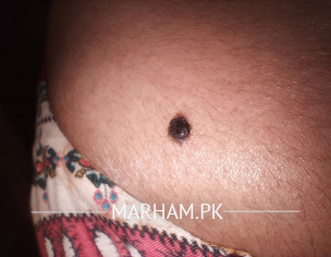 Suspecting Melanoma