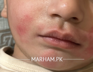 Rash On Face