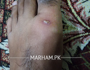 Small Wound On Foot