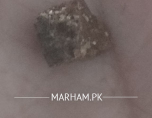 Incomplete Evacuation And Thin Stools