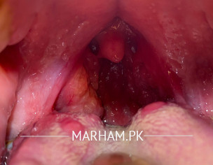 Tonsils, Tongue Ulcers 