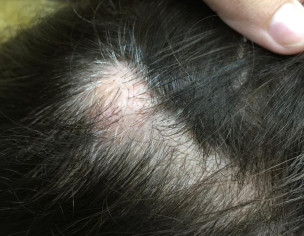 Lumps On Head And Arm