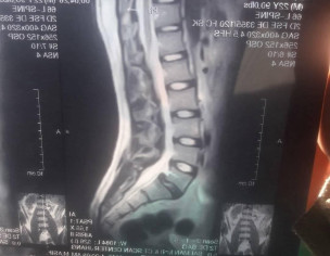 Spondylolisthesis Grade 1