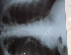 Weakness, Headaches, Numbness Etc