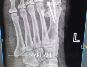 Post Operation X-ray