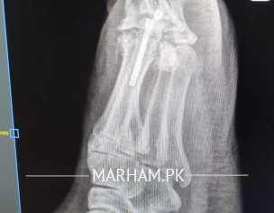 Post Operation X-ray