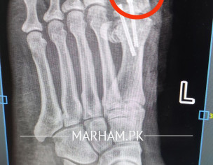 Post Operation X-ray